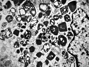 M,58y. | crystalline inclusions in hepatocyte after unknown medication